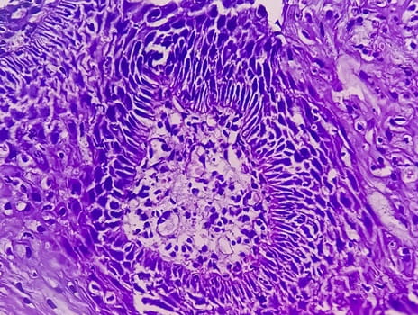 cells are visible under a microscope. They are dyed varying shades of purple.  There is an irregular pattern of cells in the middle of the image, likely a cancer tumor